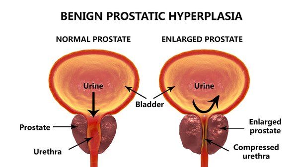 Why Cialis May Be Preferable if You Have Prostate Enlargement ...